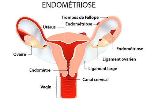 infographie d’un utérus colonisé par des foyers d’endométriose