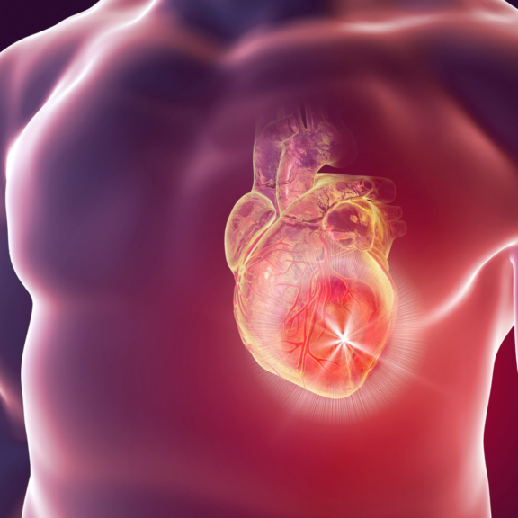 Image d'un coeur souffrant d'un infarctus silencieux qui peut être décelé grâce à l'imagerie médicale