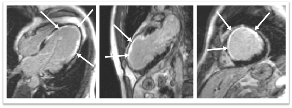 Image d'une IRM cardiaque montrant la cicatrice d'un infarctus silencieux repéré par la Dre Deac, cardiologue au sein de Medimage