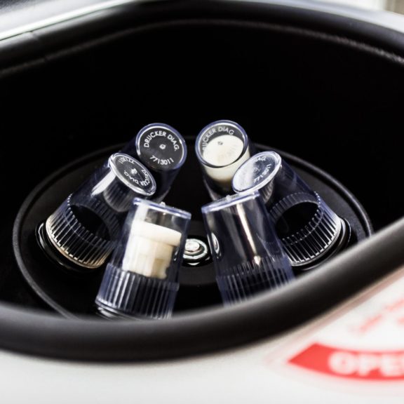 Plasma Riche en Plaquettes : une solution naturelle contre les douleurs articulaires