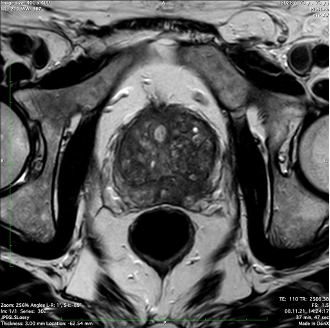 Image IRM d'un cancer de la prostate