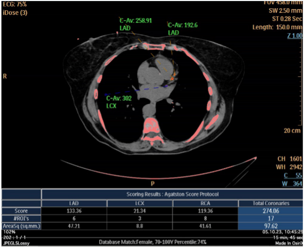 Image score calcique coronaire