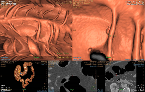 Image colonoscopie virtuelle à la recherche d'un cancer colorectal