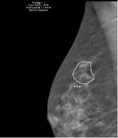 Image mammographique d'un cancer du sein