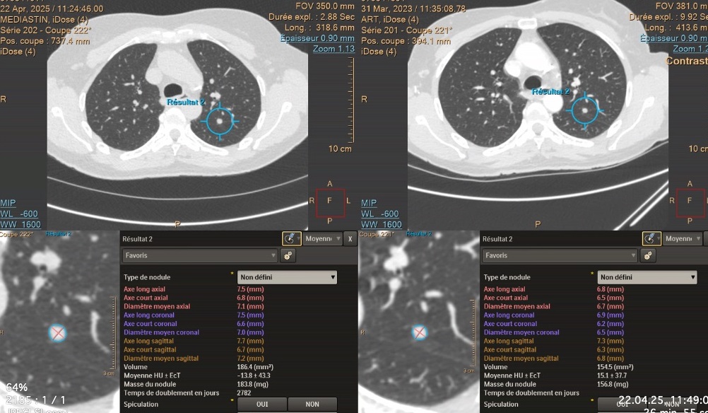 Nodule au poumon sur image scanner