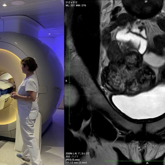 Endométriose : apport de l’échographie et de l’IRM pelviennes dans le parcours diagnostique
