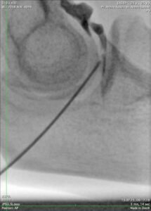 Image scanner d'un coude pendant une arthrographie