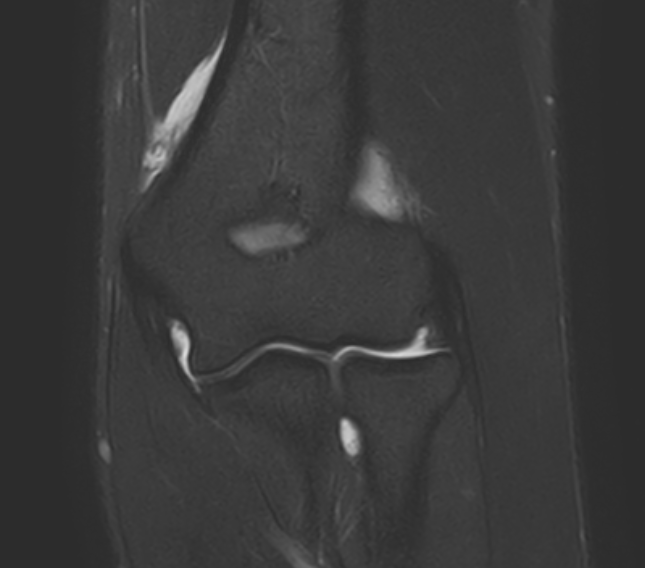 Image IRM d'un coude pendant une arthrographie