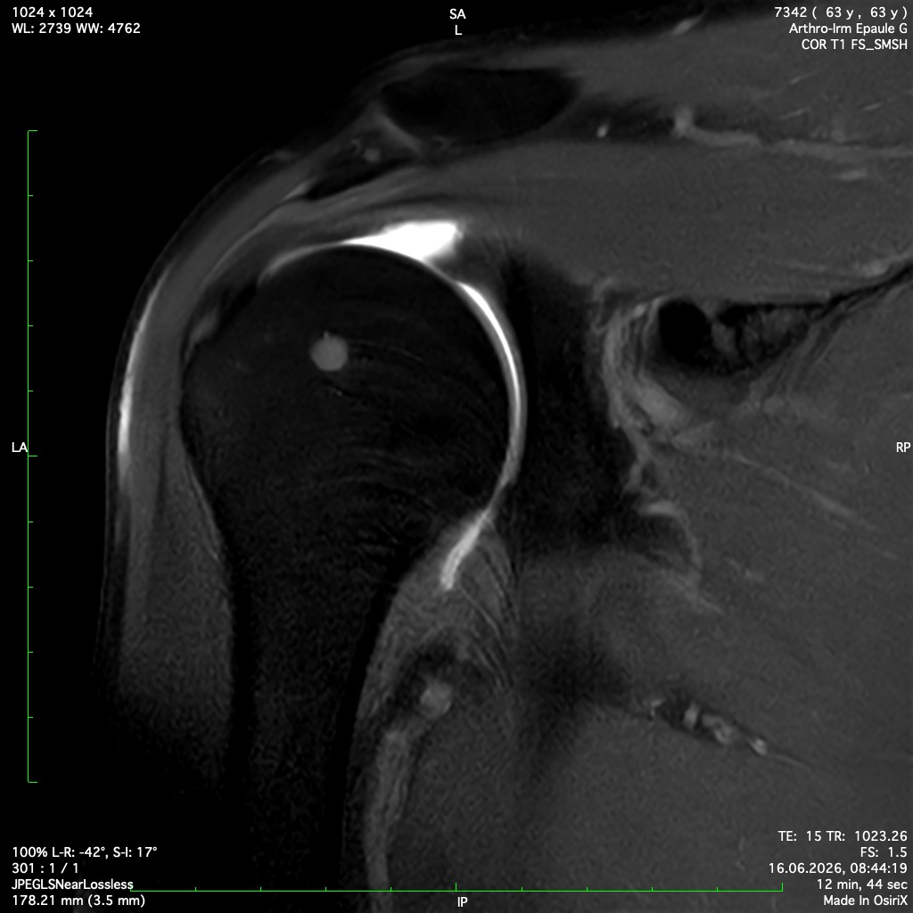 Image IRM d'une épaule pendant une arthrographie
