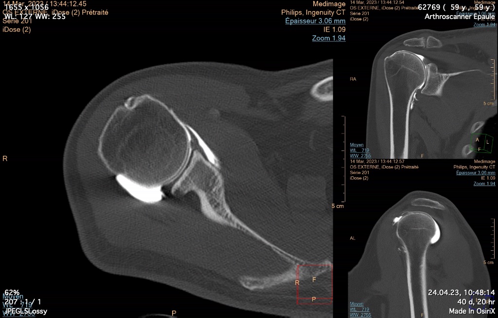 Image scanner d'une épaule pendant une arthrographie