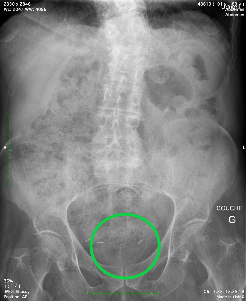 Radio d'abdomen pour observer un fécalome