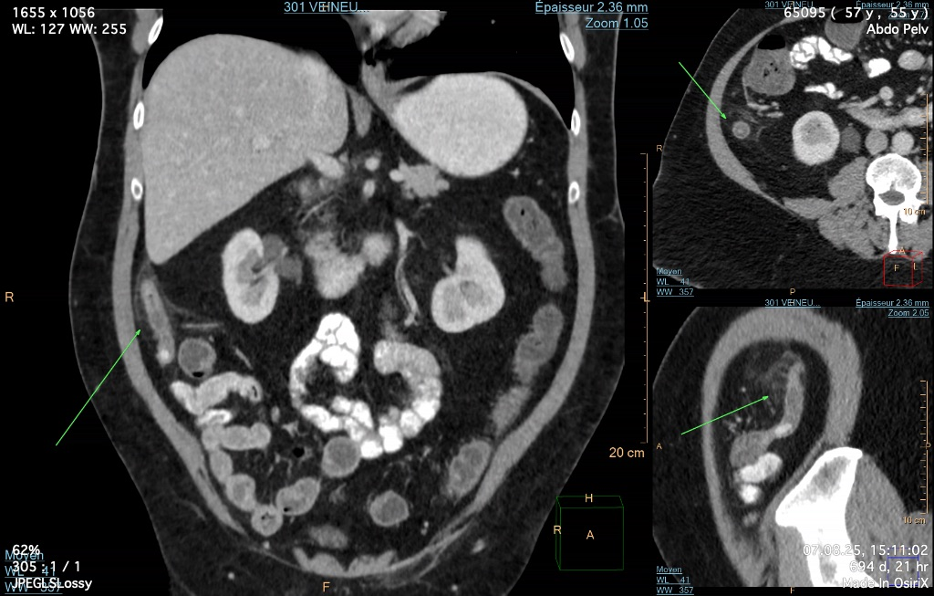 Scanner abdominal pour observer une appendicite