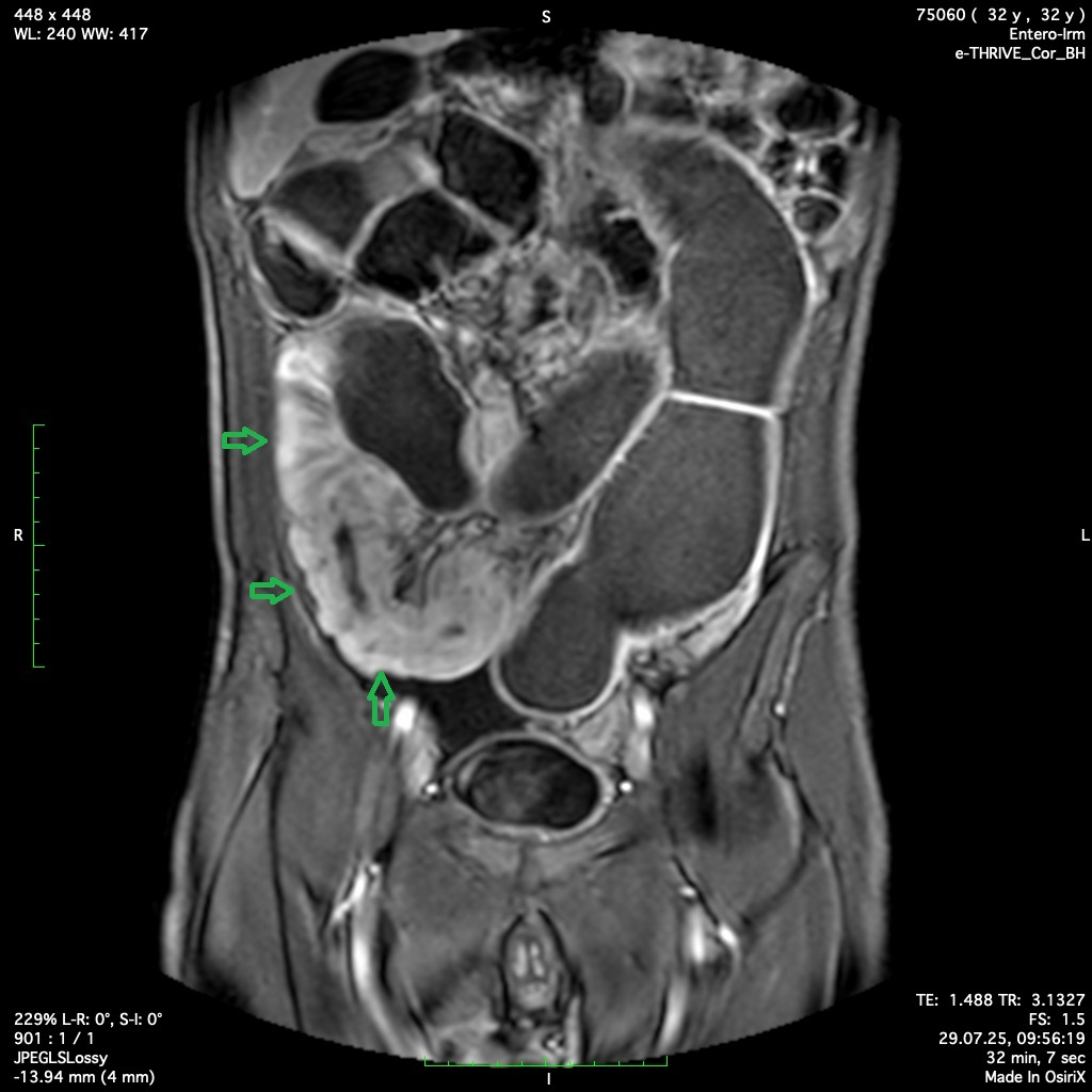 IRM abdominale pour observer une maladie de Crohn
