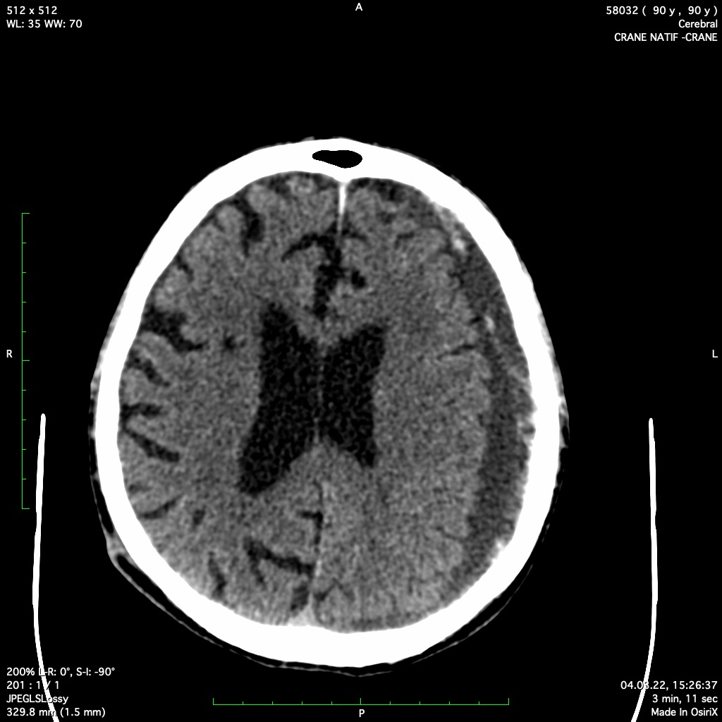 Scanner cérébral en cas de maux de tête