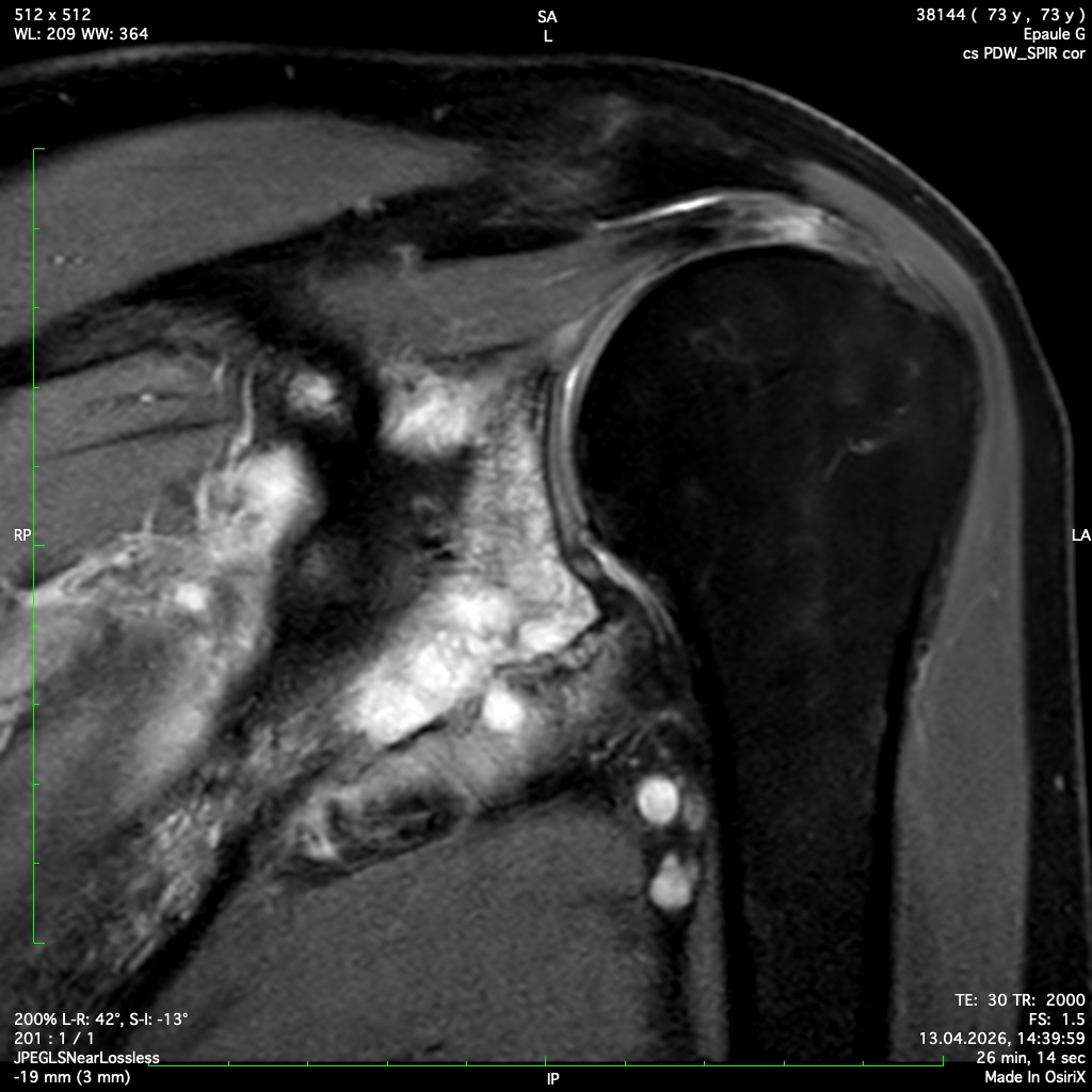 Image radiographique d'un chondrosarcome