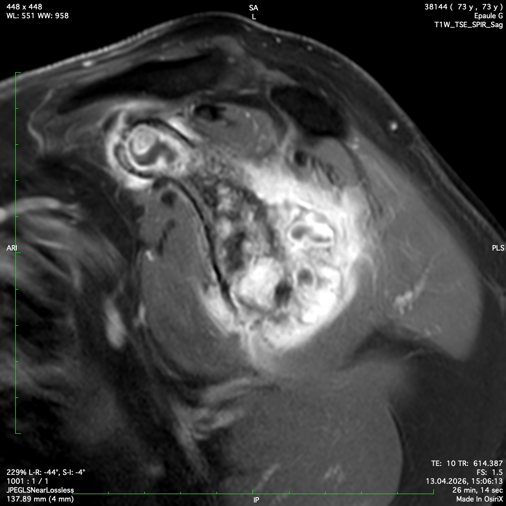 Image scanner d'une tumeur osseuse appelée chondrosarcome